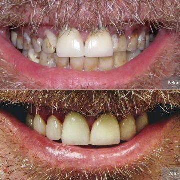 Dental Crowns
