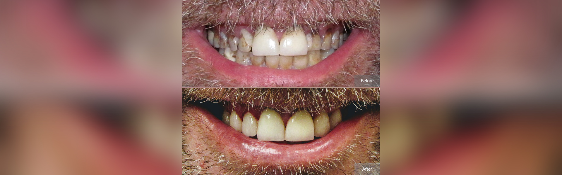 Dental Crowns in Worcester, MA