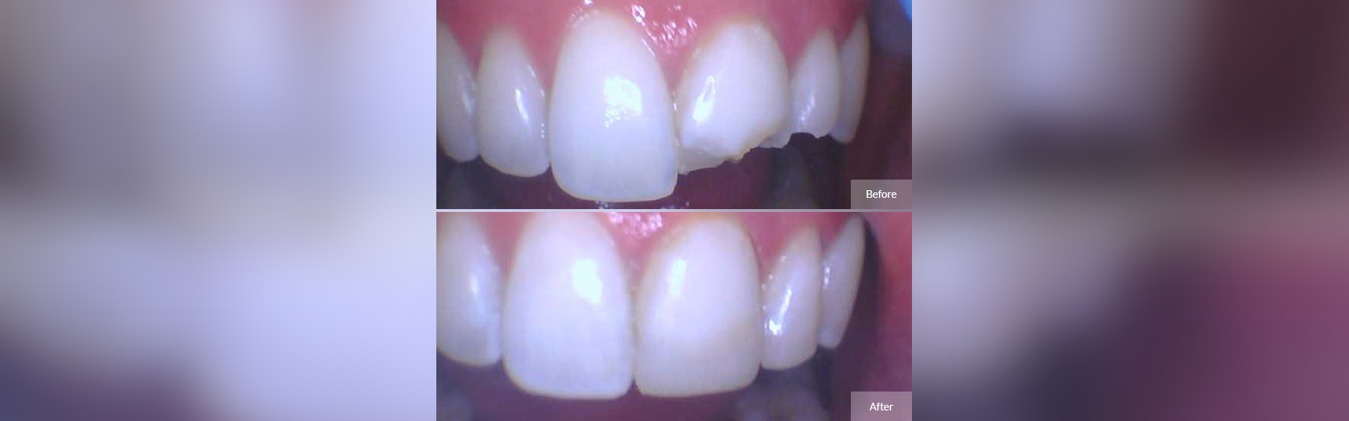 Dental Bonding in Worcester, MA