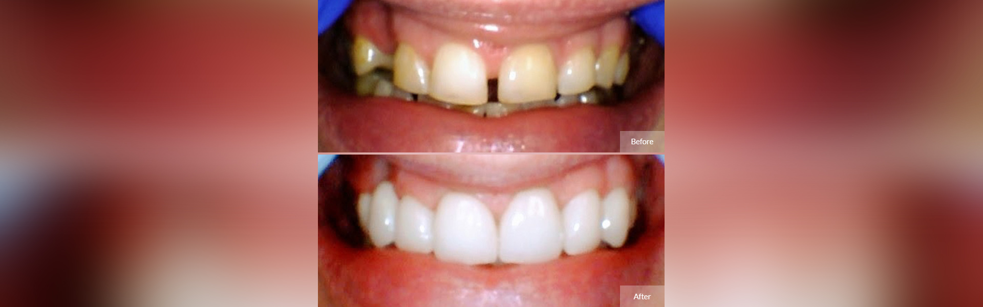 Dental Bridges in Worcester, MA