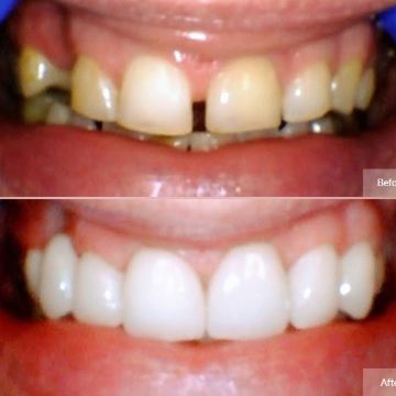 Dental Bridges