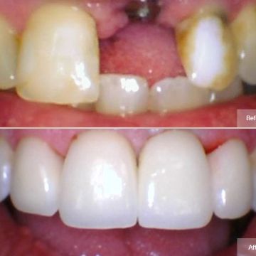 Dental Implants