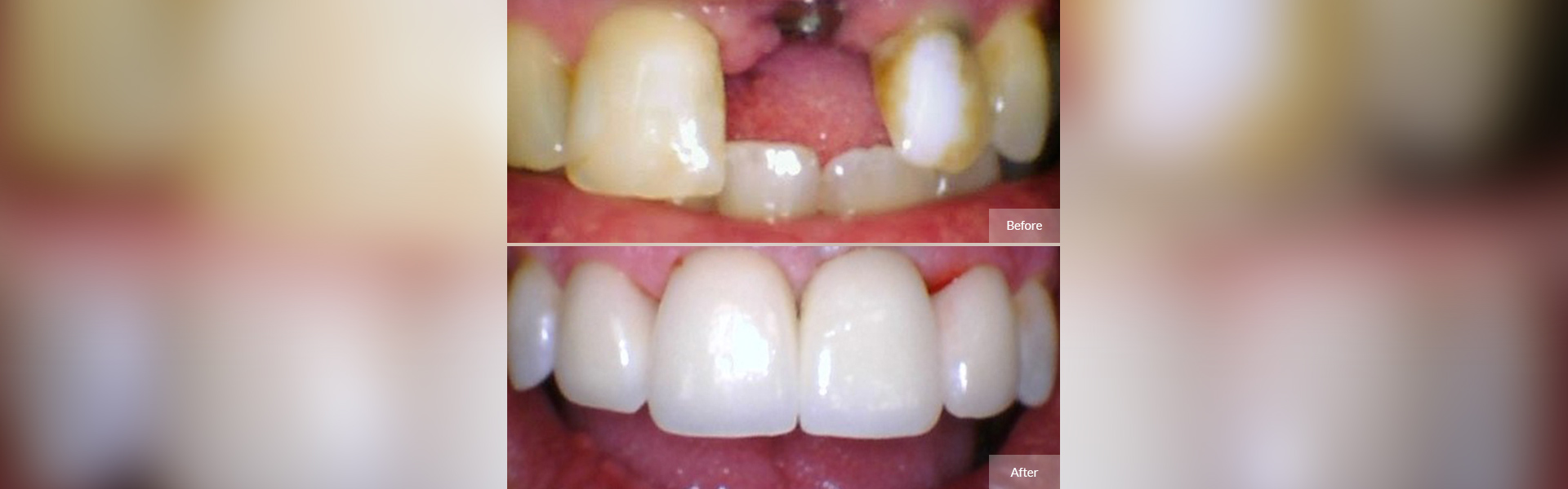 Dental Implants in Worcester, MA
