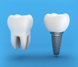 How dental implants are installed