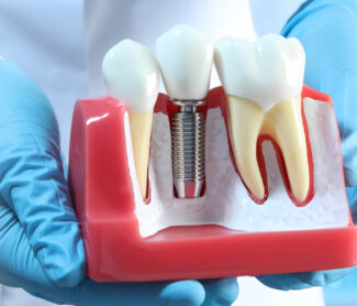 dentist showing how implants done