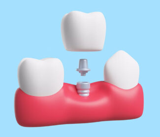 dental implant model