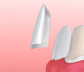 What are dental veneers and their benefits?