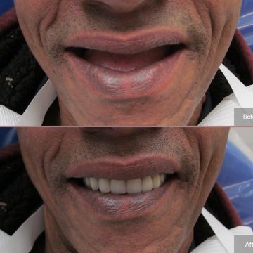 Dentures 