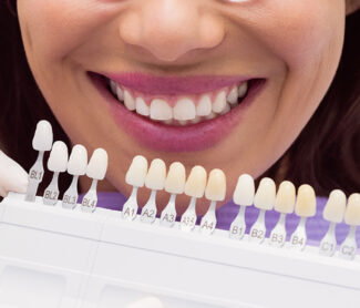 Is a Perfect Smile Possible? Exploring the Benefits of Dental Veneers