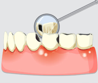 How Periodontal Treatment Helps Save Your Natural Teeth