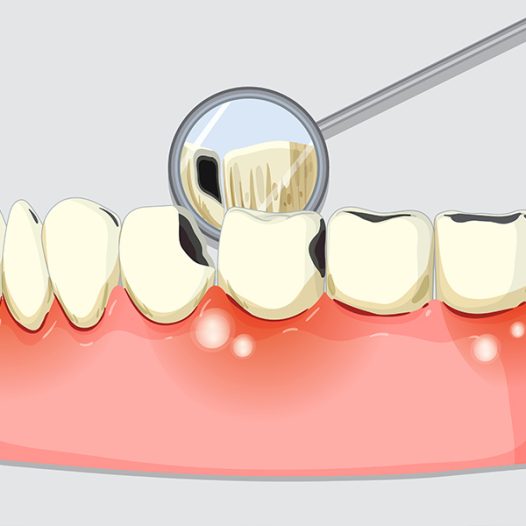 How Periodontal Treatment Helps Save Your Natural Teeth