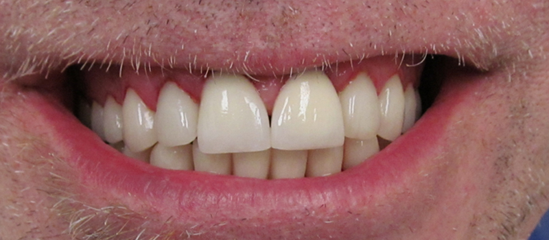 After dental treatment