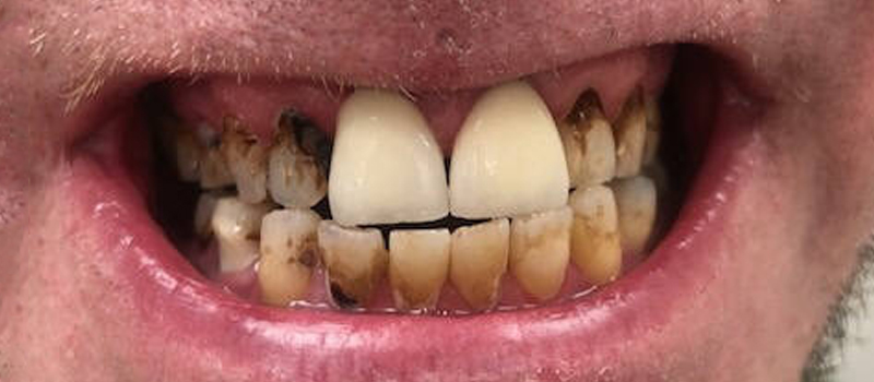 Before dental treatment
