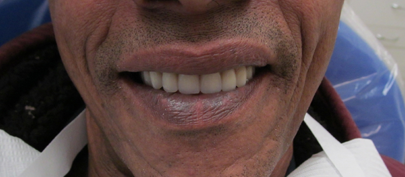 After dental restoration