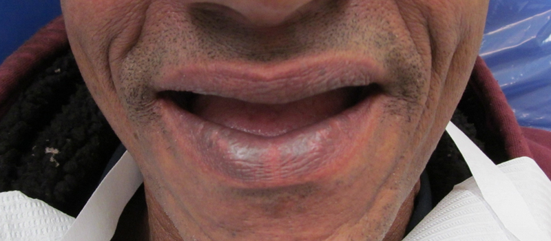 Before dental restoration