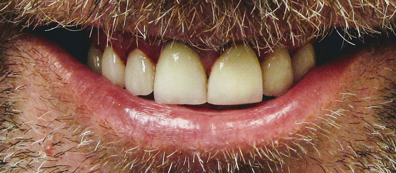 After dental treatment