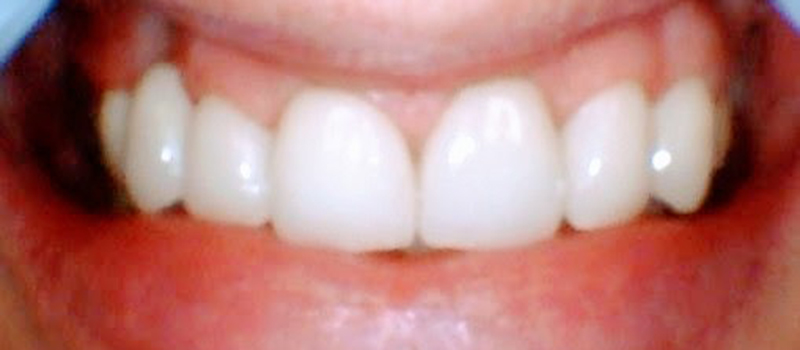 After dental treatment
