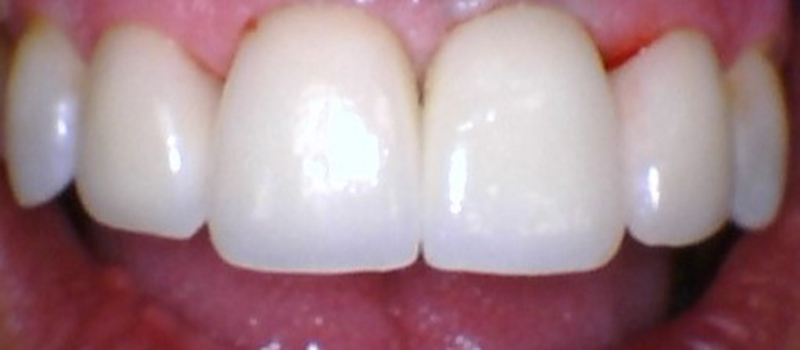 After dental treatment