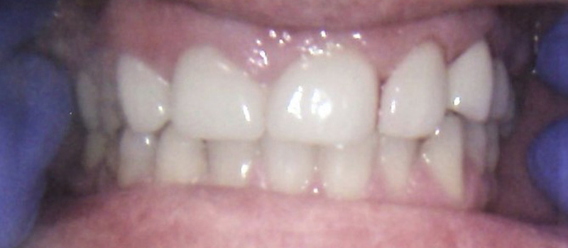 After dental treatment