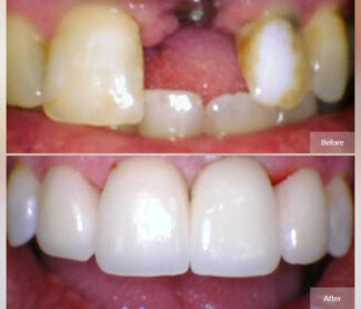 dental-implant