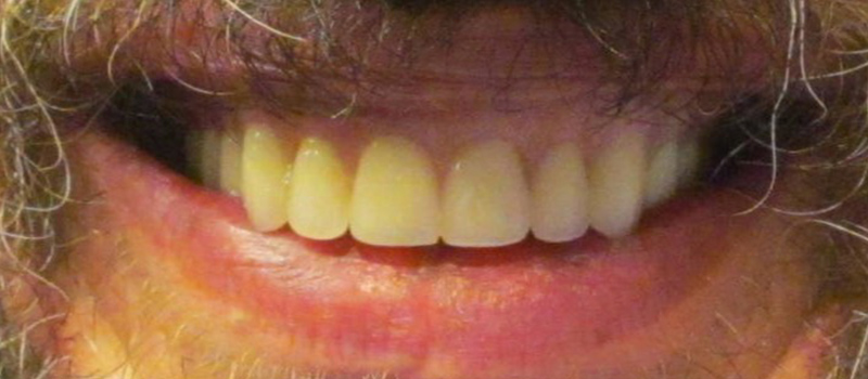 After dental treatment