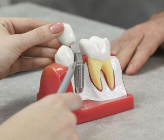 What to Expect During Dental Implant Recovery