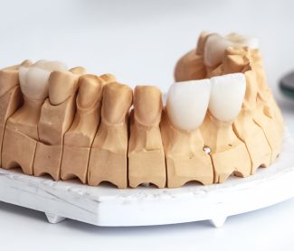 Can Dental Veneers Fix Worn Teeth? Everything You Need to Know